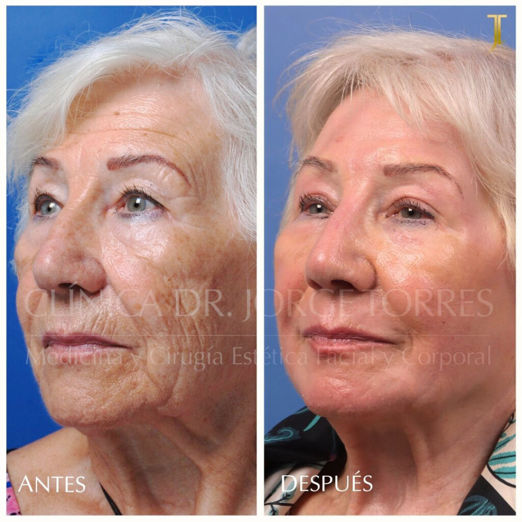 Peeling Profundo. Medicina y Cirugía Estética Facial y Corporal en Valencia Dr. Jorge Torres