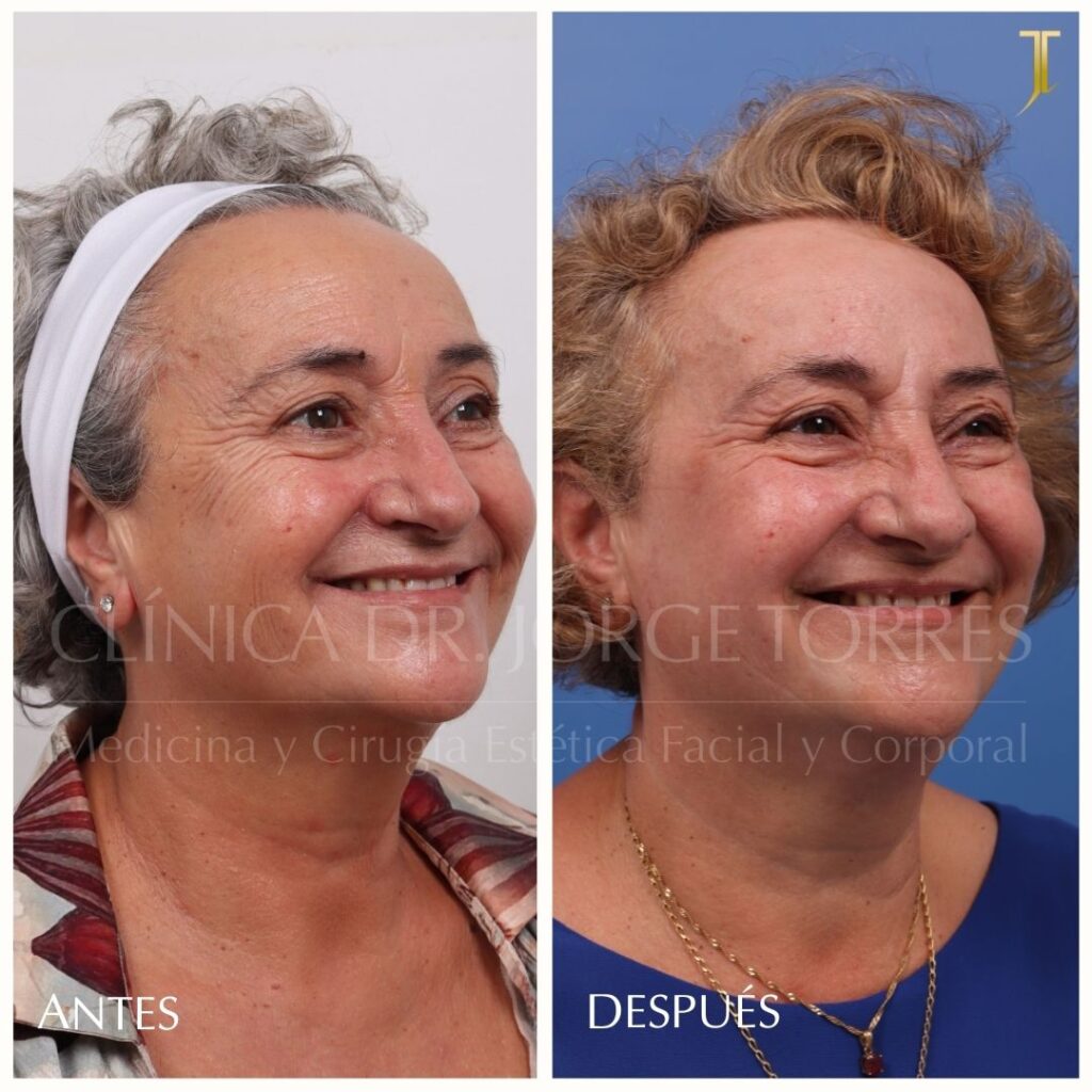Peeling Profundo. Medicina y Cirugía Estética Facial y Corporal en Valencia Dr. Jorge Torres