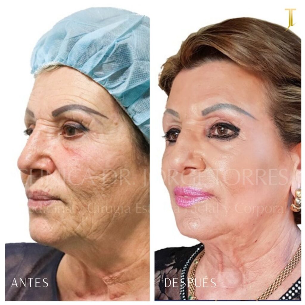 Peeling Profundo. Medicina y Cirugía Estética Facial y Corporal en Valencia Dr. Jorge Torres