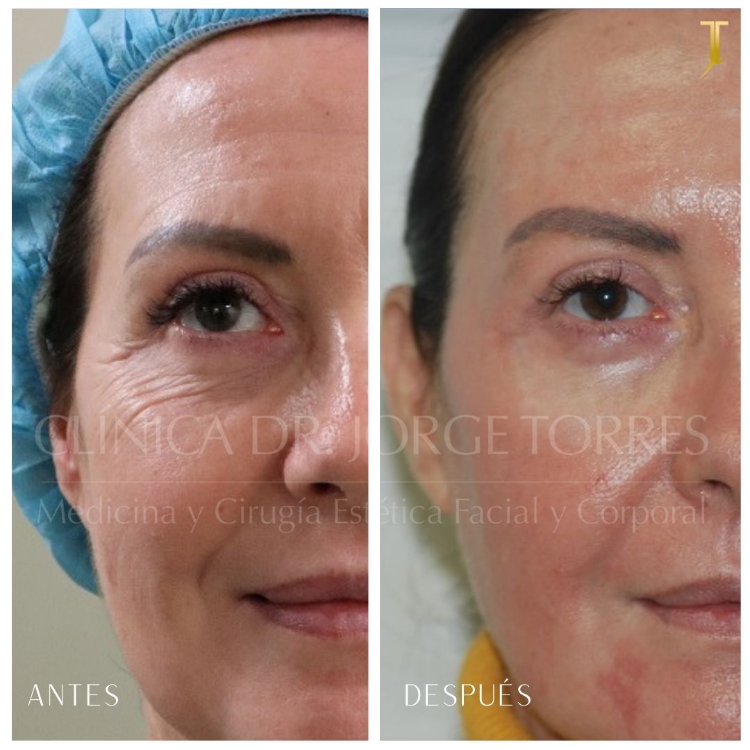 Peeling Profundo. Medicina y Cirugía Estética Facial y Corporal en Valencia Dr. Jorge Torres