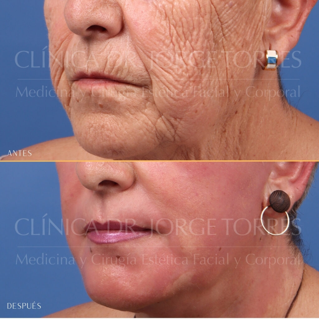 PEELING PROFUNDO + LIFTING FACIAL DE PLANO PROFUNDO