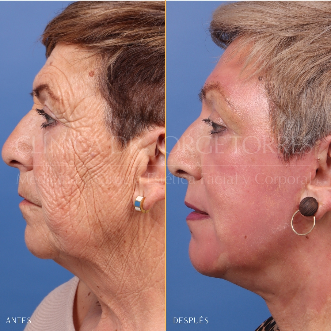 Lifting Deep Plane, tratamiento de rejuvenecimiento facial,