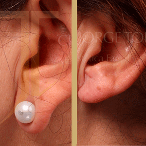 Lobuloplastia o cirugía del lóbulo de la oreja en Valencia